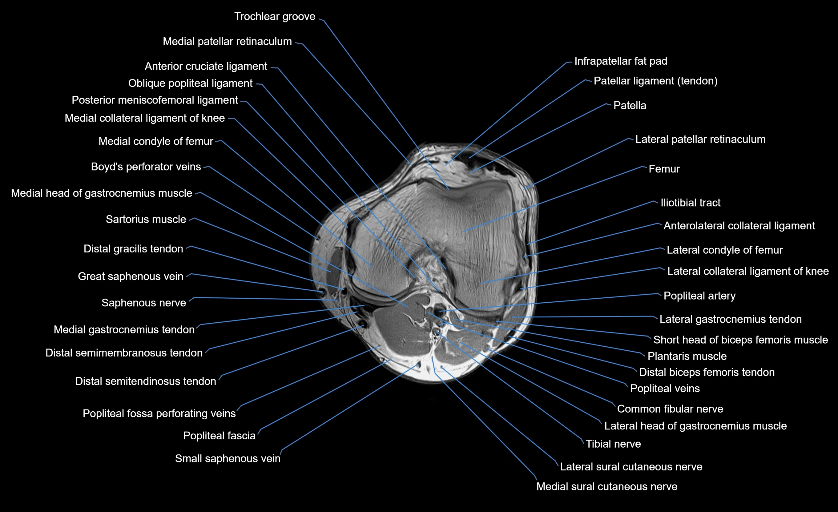 MRI lower leg axial cross sectional anatomy 3T  radiology  image-img-00001-00012.webp
